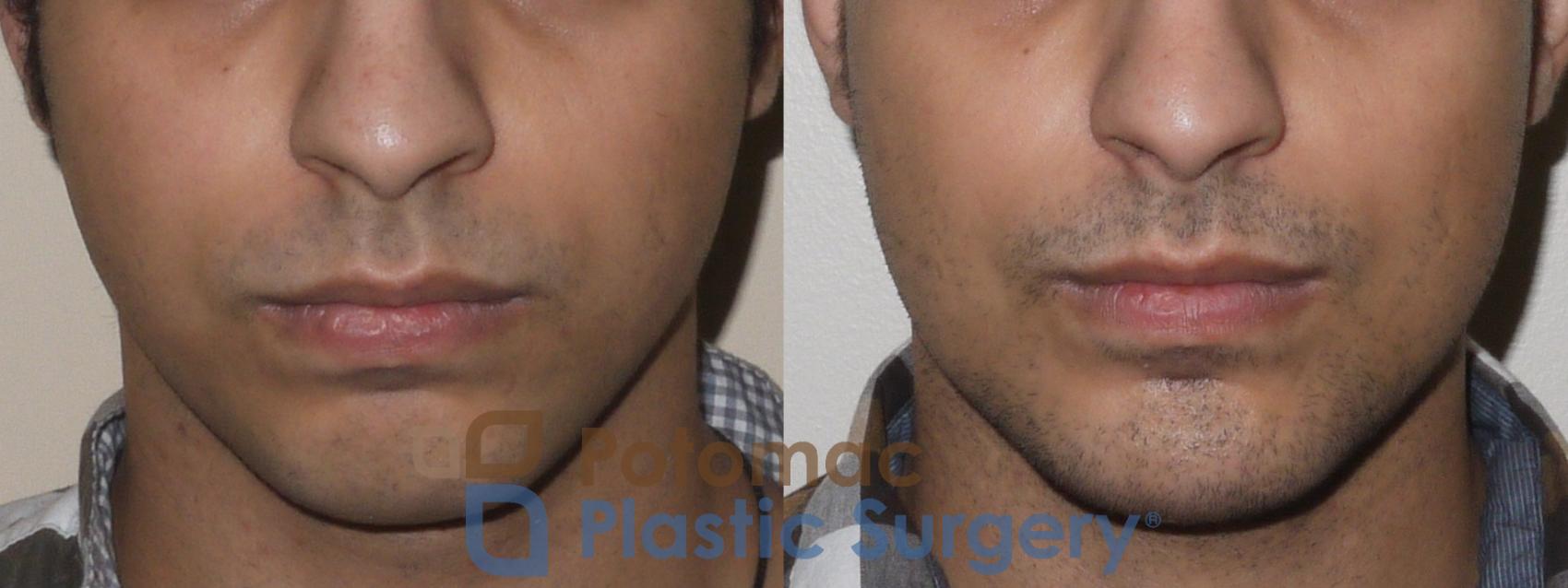 male jaw implant before and after