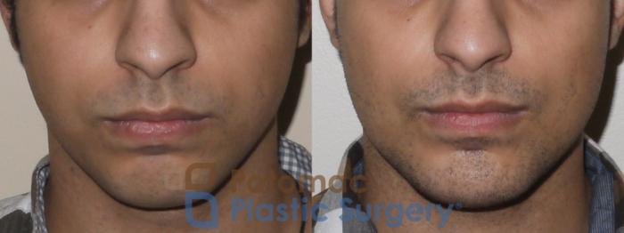 Before & After Facial Sculpting Case 51 Front View in Washington, DC