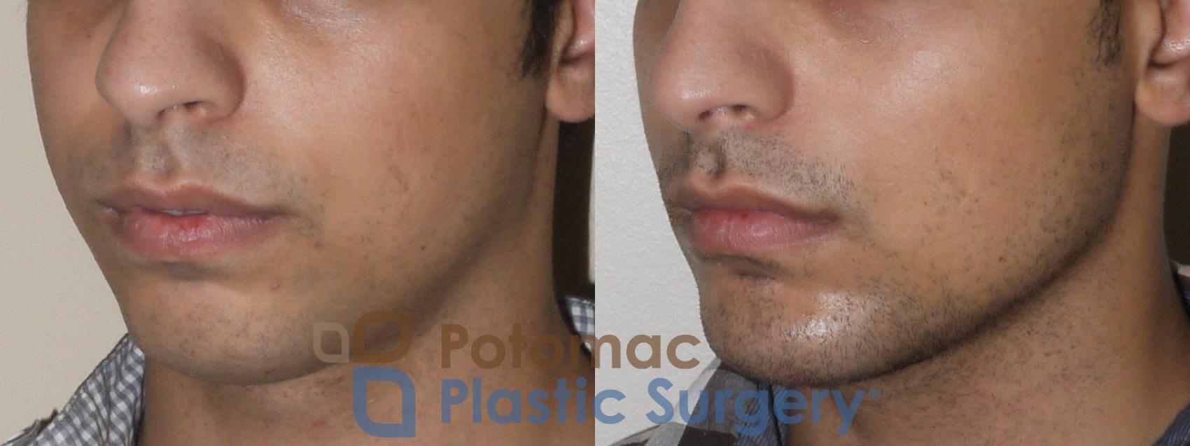 Before & After Chin Augmentation Case 51 Left Oblique View in Washington, DC