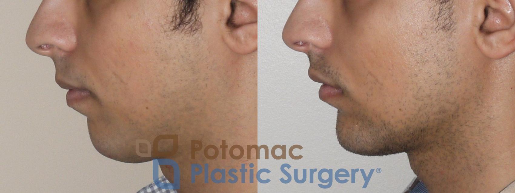 Before & After Chin Augmentation Case 51 Left Side View in Washington, DC