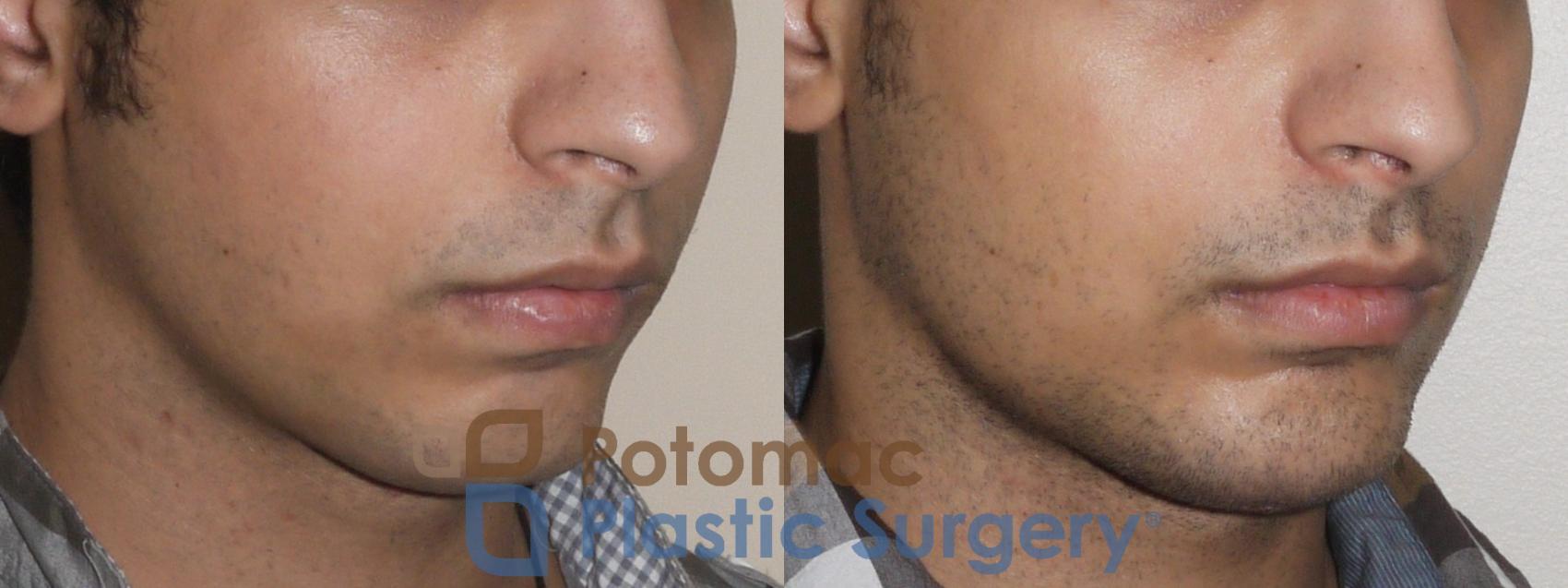Before & After Chin Augmentation Case 51 Right Oblique View in Washington, DC