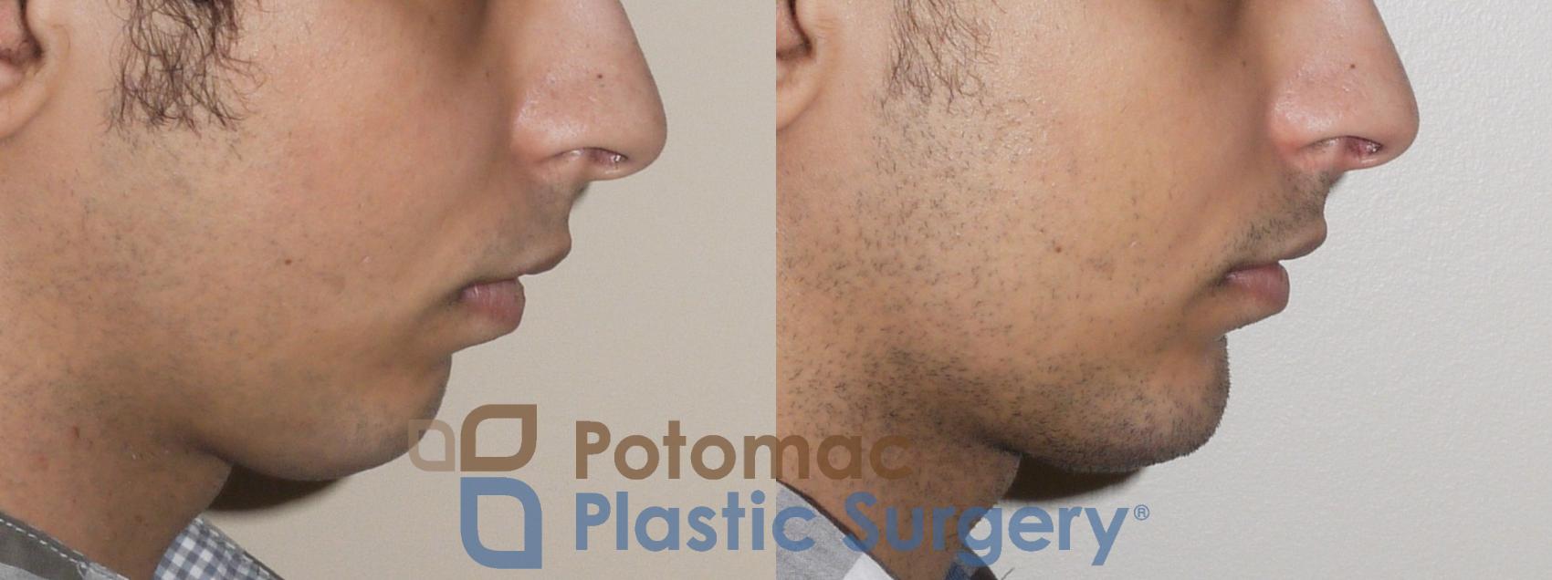 Before & After Chin Augmentation Case 51 Right Side View in Washington, DC