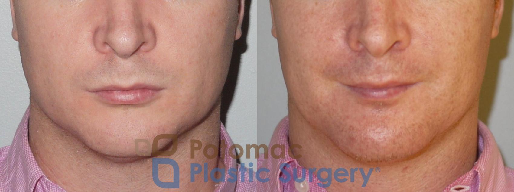 Before & After Chin Augmentation Case 79 Front View in Washington, DC