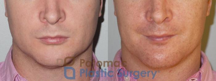 Before & After Facial Sculpting Case 79 Front View in Washington DC & Arlington , DC