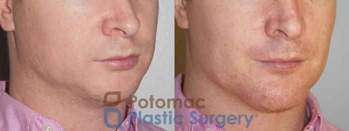 Before & After Chin Augmentation Case 79 Right Oblique View in Washington DC & Arlington , DC