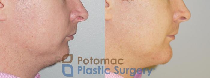 Before & After Chin Augmentation Case 79 Right Side View in Washington DC & Arlington , DC