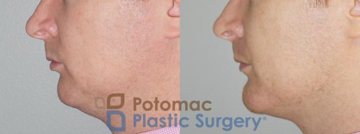 Before & After Chin Augmentation Case 79 View #5 View in Washington DC & Arlington , DC