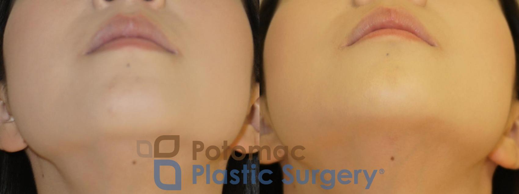 Before & After Facial Sculpting Case 81 Bottom View in Washington DC & Arlington , DC