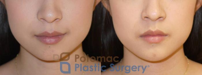 Before & After Liquid Facelift Case 81 Front View in Washington DC & Arlington , DC
