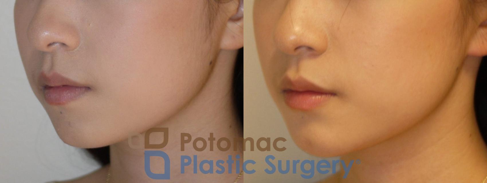 Before & After Facial Sculpting Case 81 Left Oblique View in Washington DC & Arlington , DC