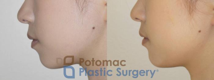 Before & After Chin Augmentation Case 81 Left Side View in Washington DC & Arlington , DC
