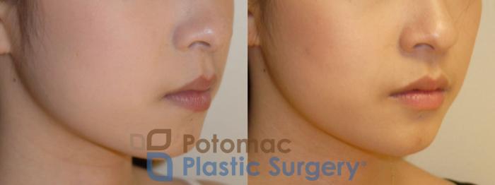 Before & After Chin Augmentation Case 81 Right Oblique View in Washington DC & Arlington , DC