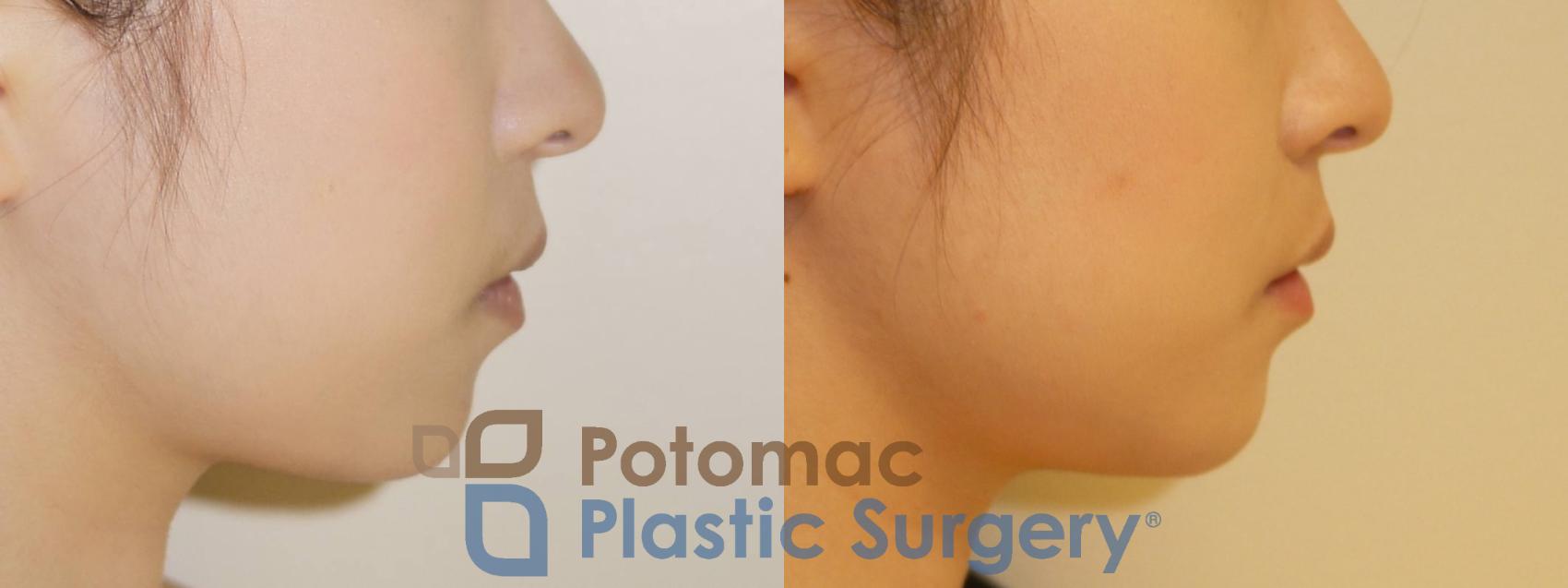 Before & After Facial Sculpting Case 81 Right Side View in Washington DC & Arlington , DC
