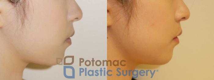 Before & After Chin Augmentation Case 81 Right Side View in Washington DC & Arlington , DC