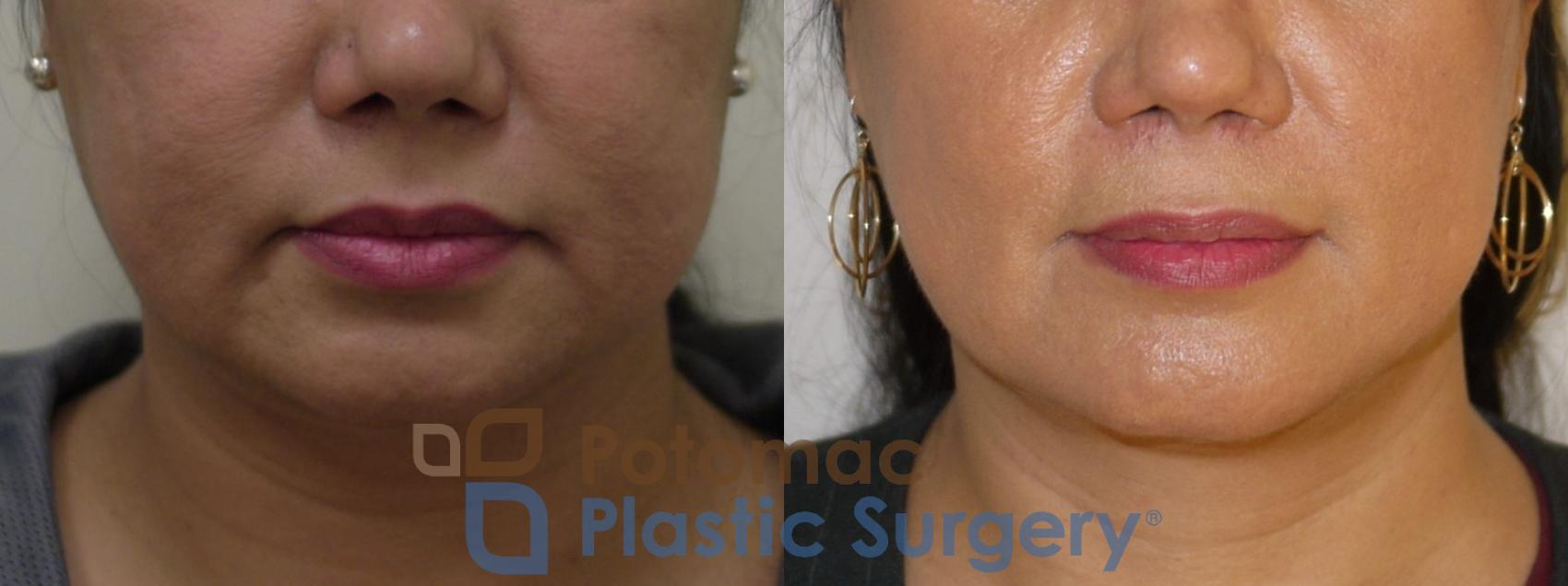 Before & After Chin Augmentation Case 90 Front View in Washington, DC
