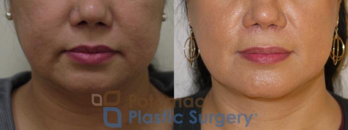 Before & After Neck Lift Case 90 Front View in Washington DC & Arlington , DC