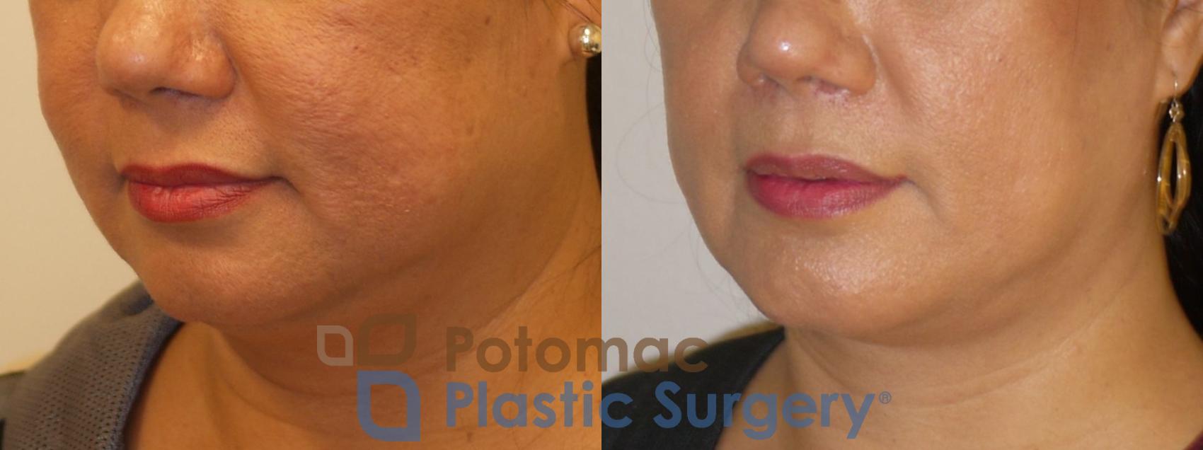 Before & After Neck Lift Case 90 Left Oblique View in Washington DC & Arlington , DC