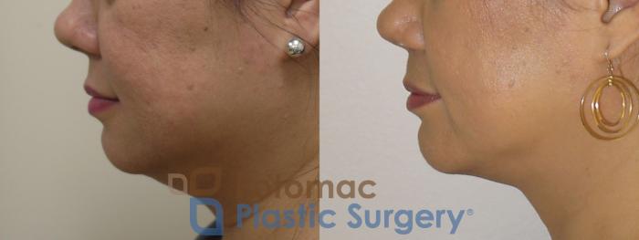 Before & After Chin Augmentation Case 90 Left Side View in Arlington, VA & Washington, DC