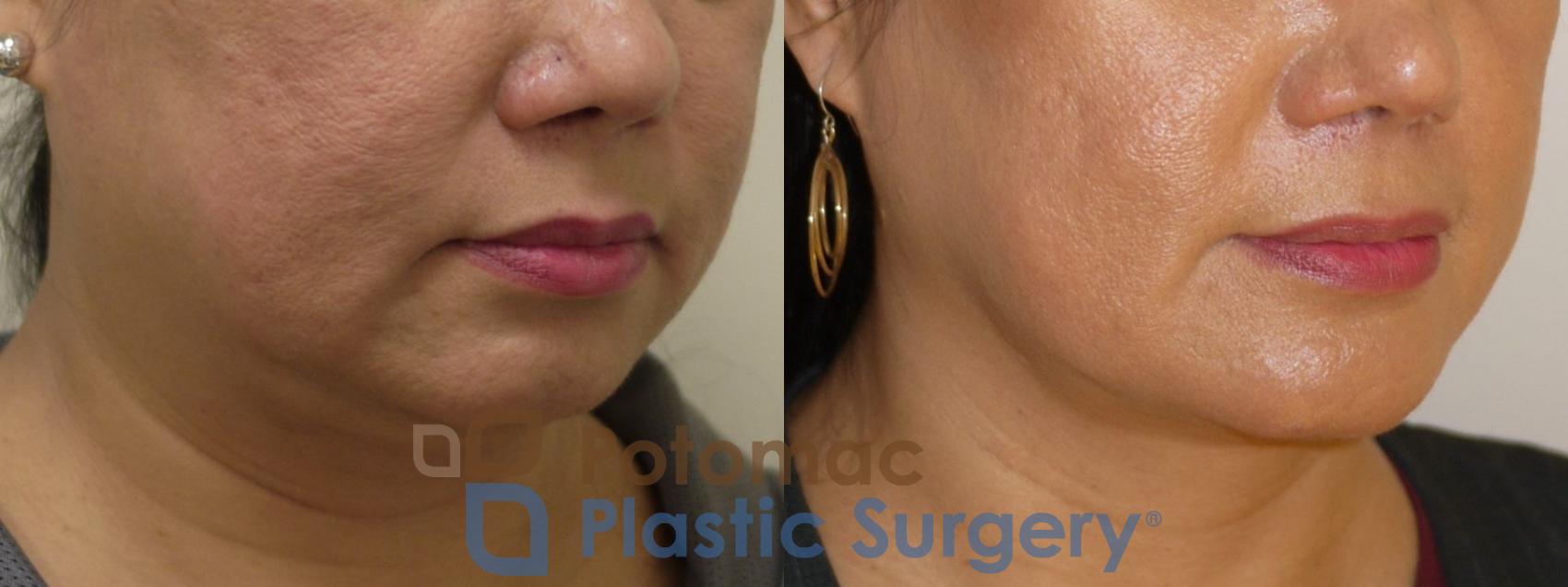 Before & After Chin Augmentation Case 90 Right Oblique View in Washington, DC