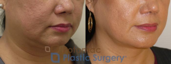Before & After Chin Augmentation Case 90 Right Oblique View in Arlington, VA & Washington, DC