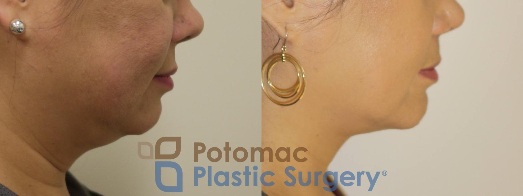 Before & After Chin Augmentation Case 90 Right Side View in Washington, DC