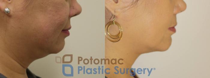 Before & After Chin Augmentation Case 90 Right Side View in Arlington, VA & Washington, DC