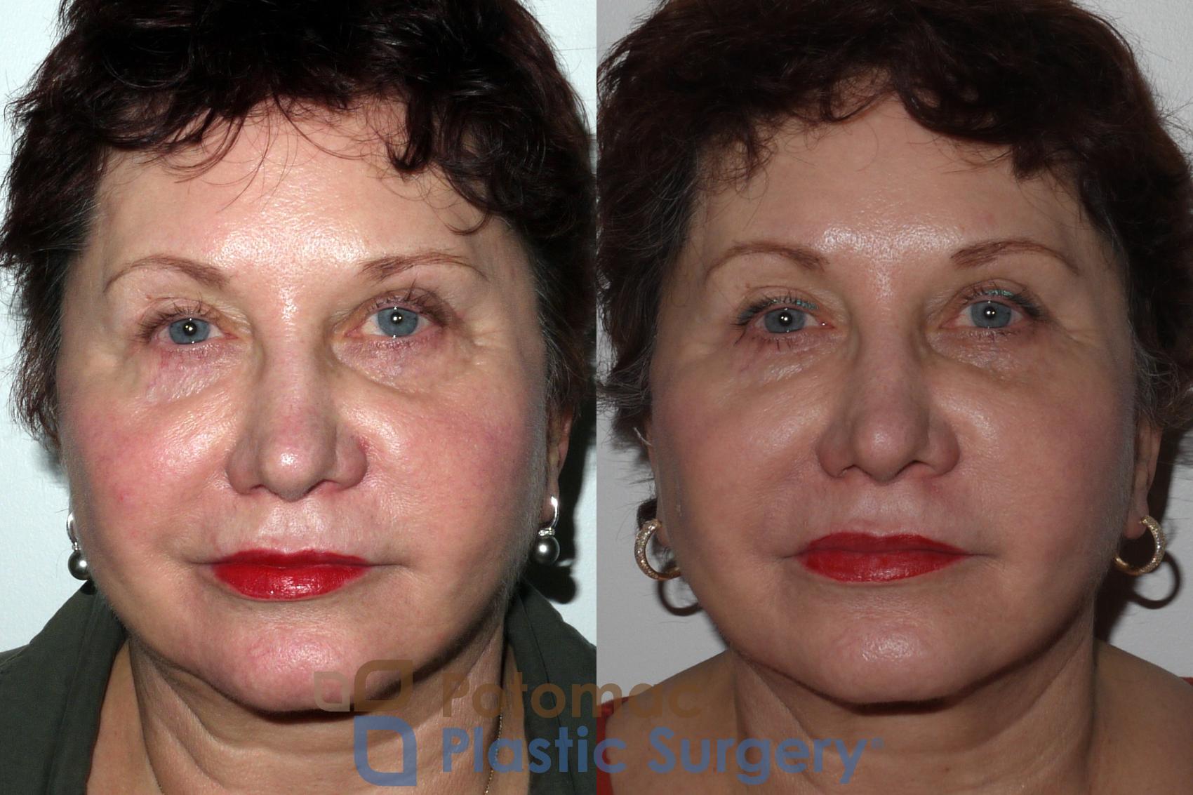 Before & After Dermal Fillers Case 139 Front View in Washington DC & Arlington , DC