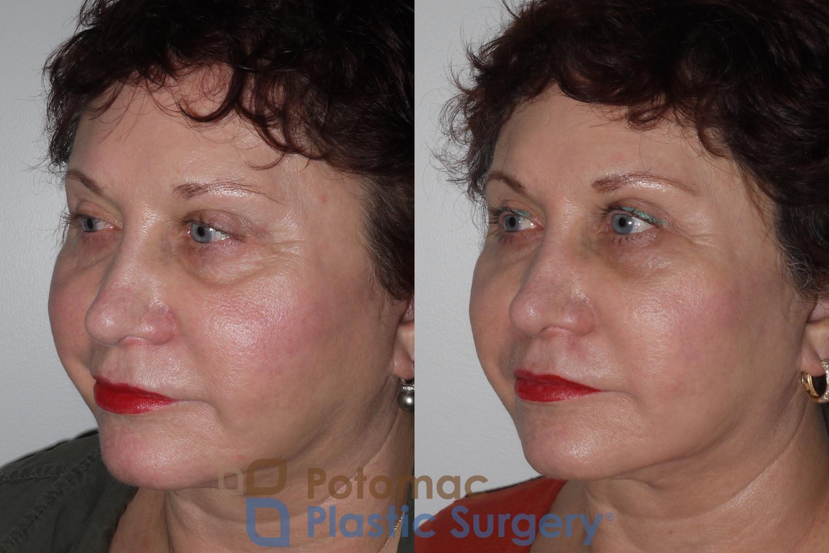 Before & After Liquid Facelift Case 139 Left Oblique View in Washington DC & Arlington , DC