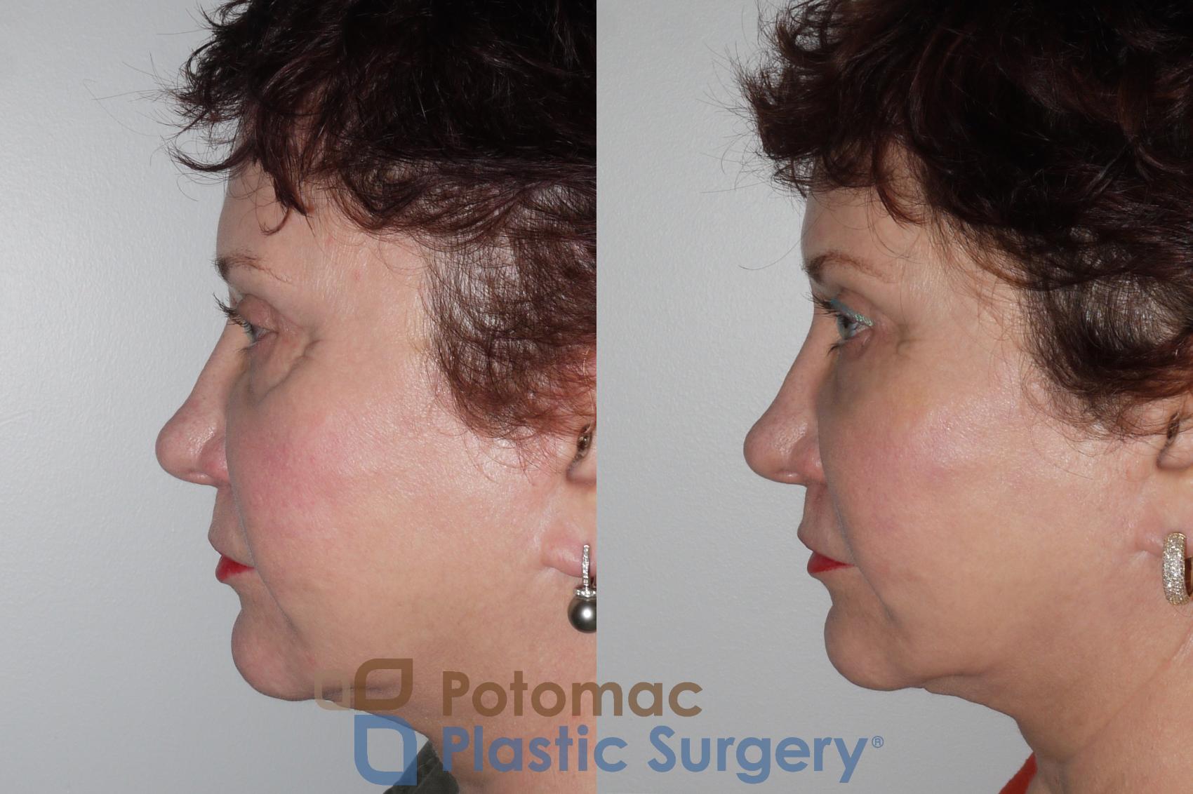 Before & After Liquid Facelift Case 139 Left Side View in Washington DC & Arlington , DC