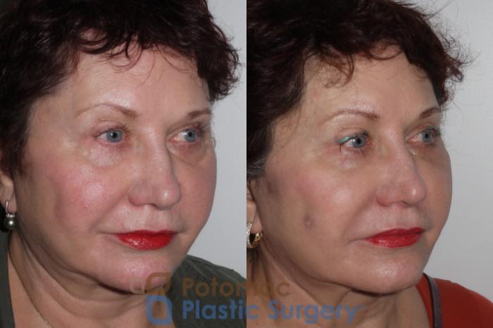 Before & After Dermal Fillers Case 139 Right Oblique View in Washington DC & Arlington , DC