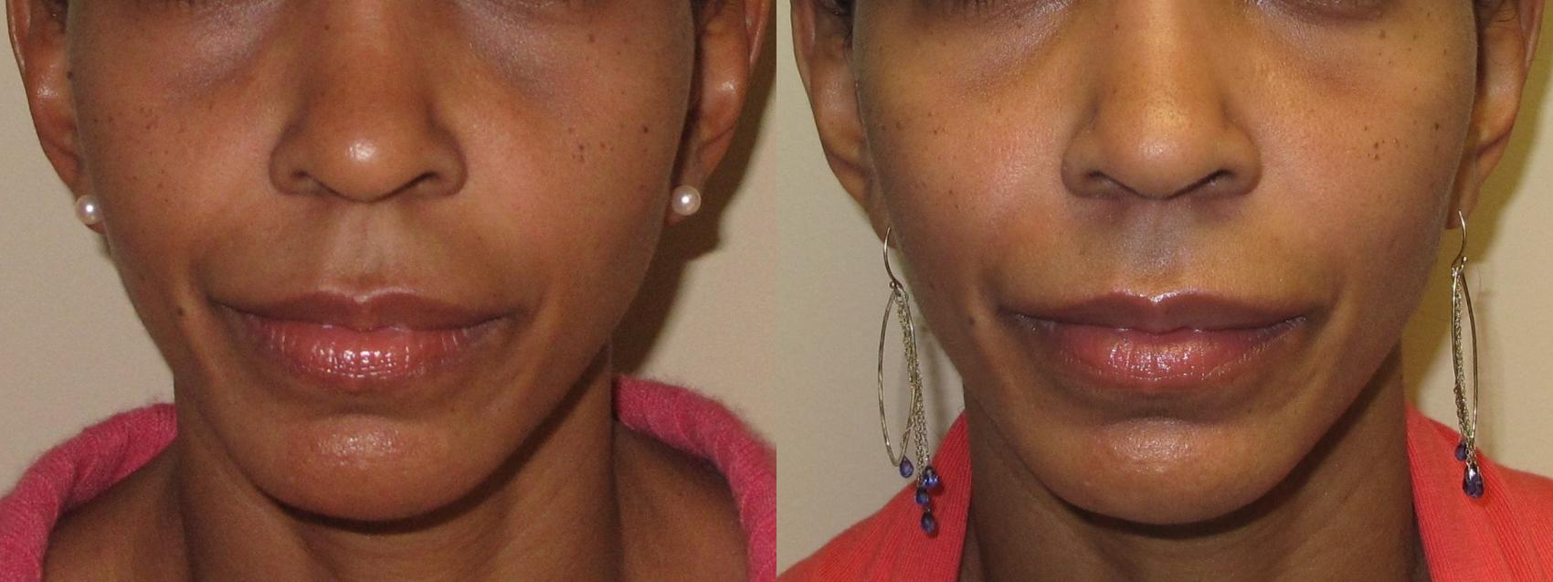 Before & After Liquid Facelift Case 16 Front View in Washington DC & Arlington , DC