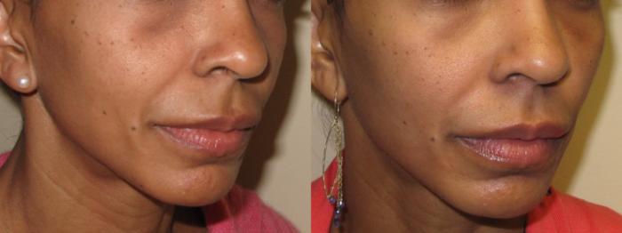 Before & After Dermal Fillers Case 16 Right Oblique View in Washington, DC