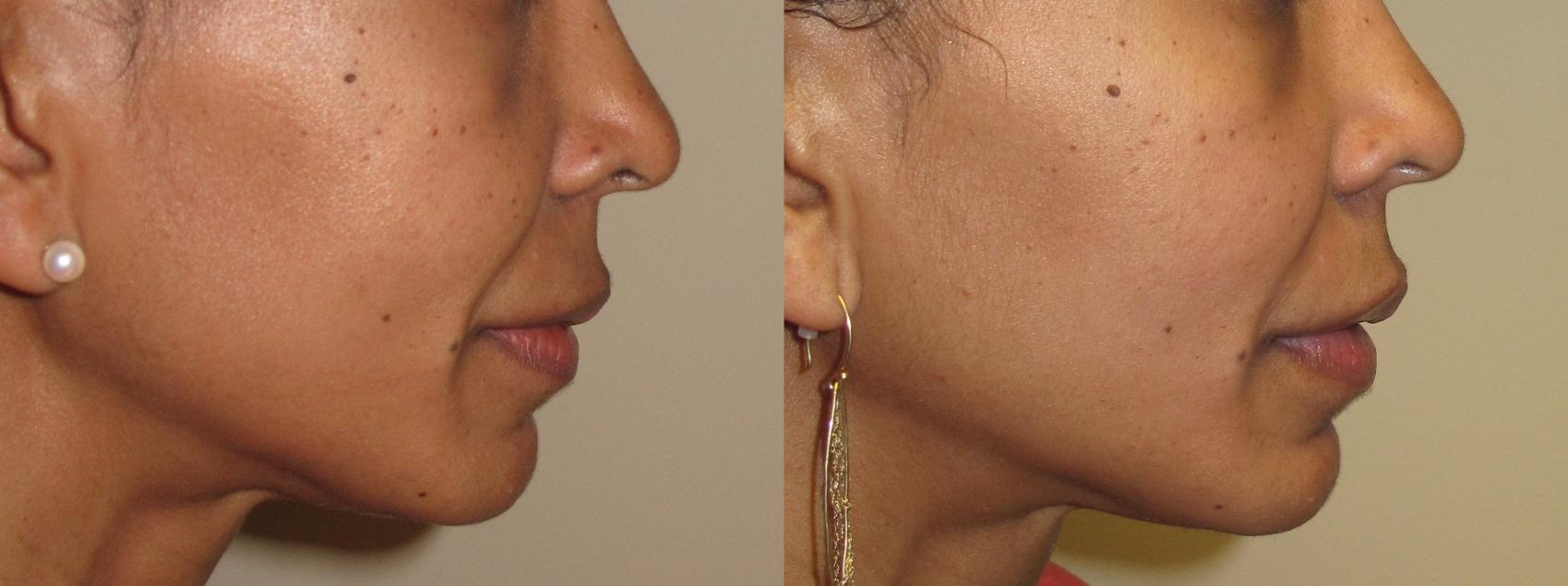 Before & After Dermal Fillers Case 16 Right Side View in Washington, DC