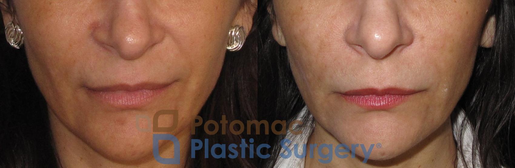 Before & After Liquid Facelift Case 17 Front View in Washington, DC