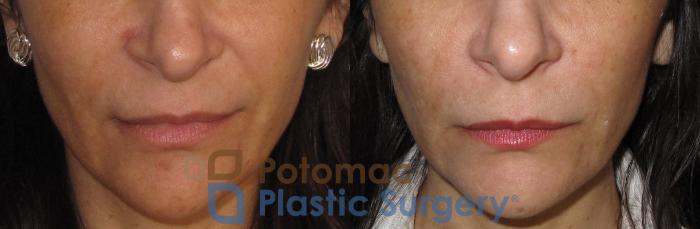 Before & After Dermal Fillers Case 17 Front View in Washington, DC