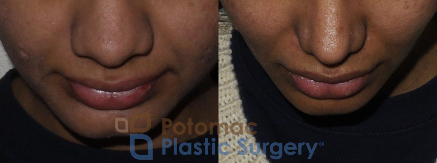 Before & After Dermal Fillers Case 195 Above View in Washington, DC