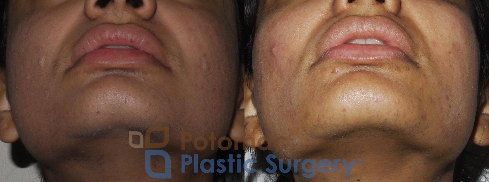 Before & After Dermal Fillers Case 195 Below View in Washington, DC