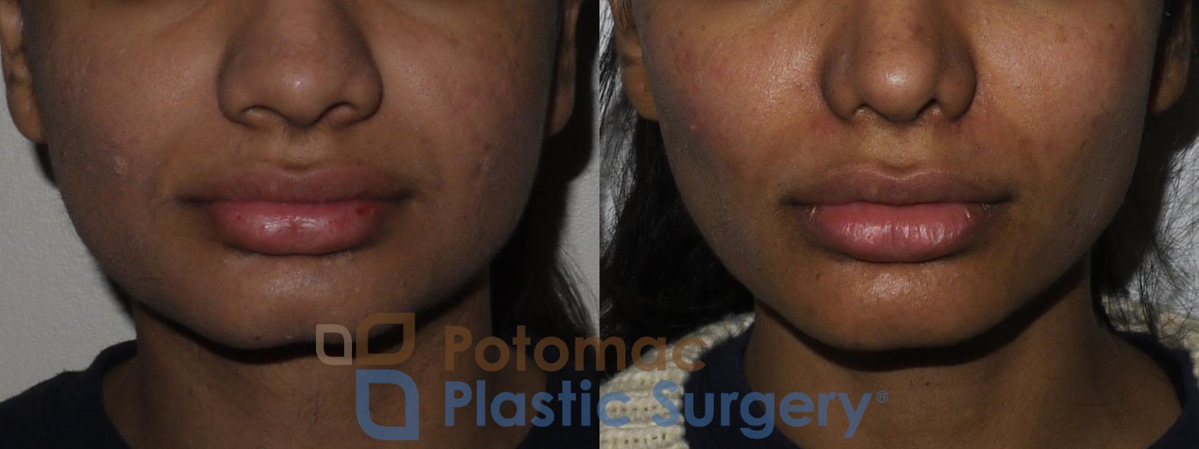 Before & After Liquid Facelift Case 195 Front View in Washington, DC