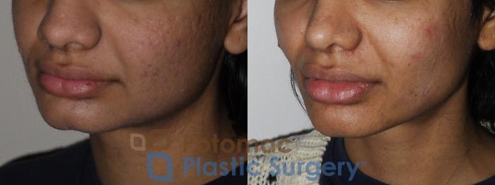 Before & After Botox Cosmetic Case 195 Left Oblique View in Washington DC & Arlington , DC