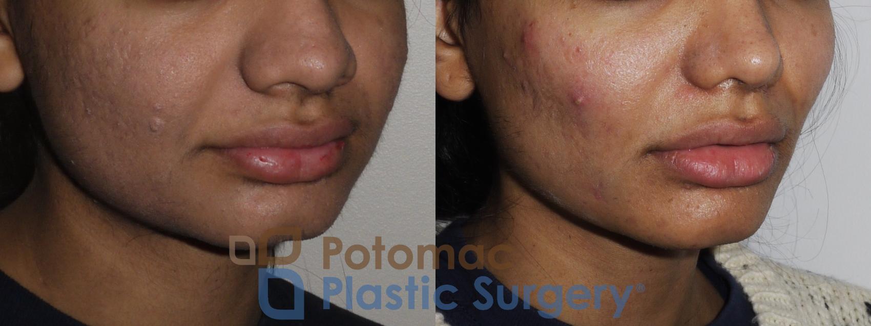 Before & After Dermal Fillers Case 195 Right Oblique View in Washington, DC