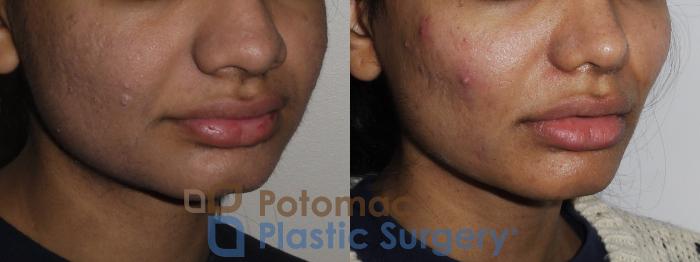 Before & After Liquid Facelift Case 195 Right Oblique View in Washington, DC