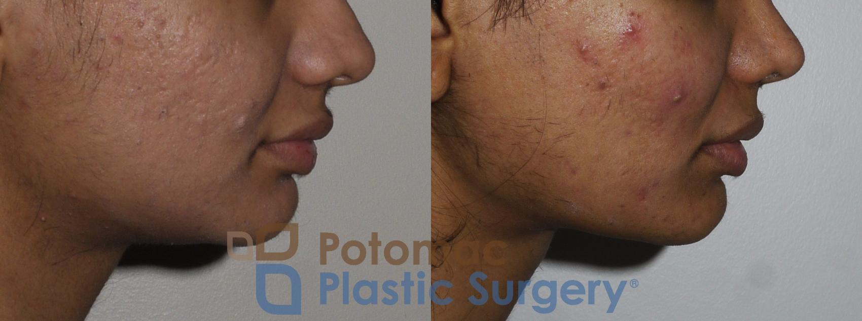 Before & After Dermal Fillers Case 195 Right Side View in Washington, DC
