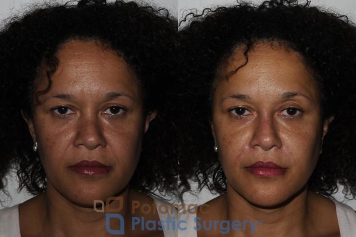 Before & After Rhinoplasty - Cosmetic Case 209 Front View in Washington DC & Arlington , DC