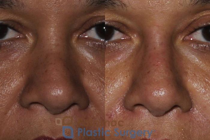 Before & After Rhinoplasty - Cosmetic Case 209 Front View Close-Up #1 View in Washington DC & Arlington , DC