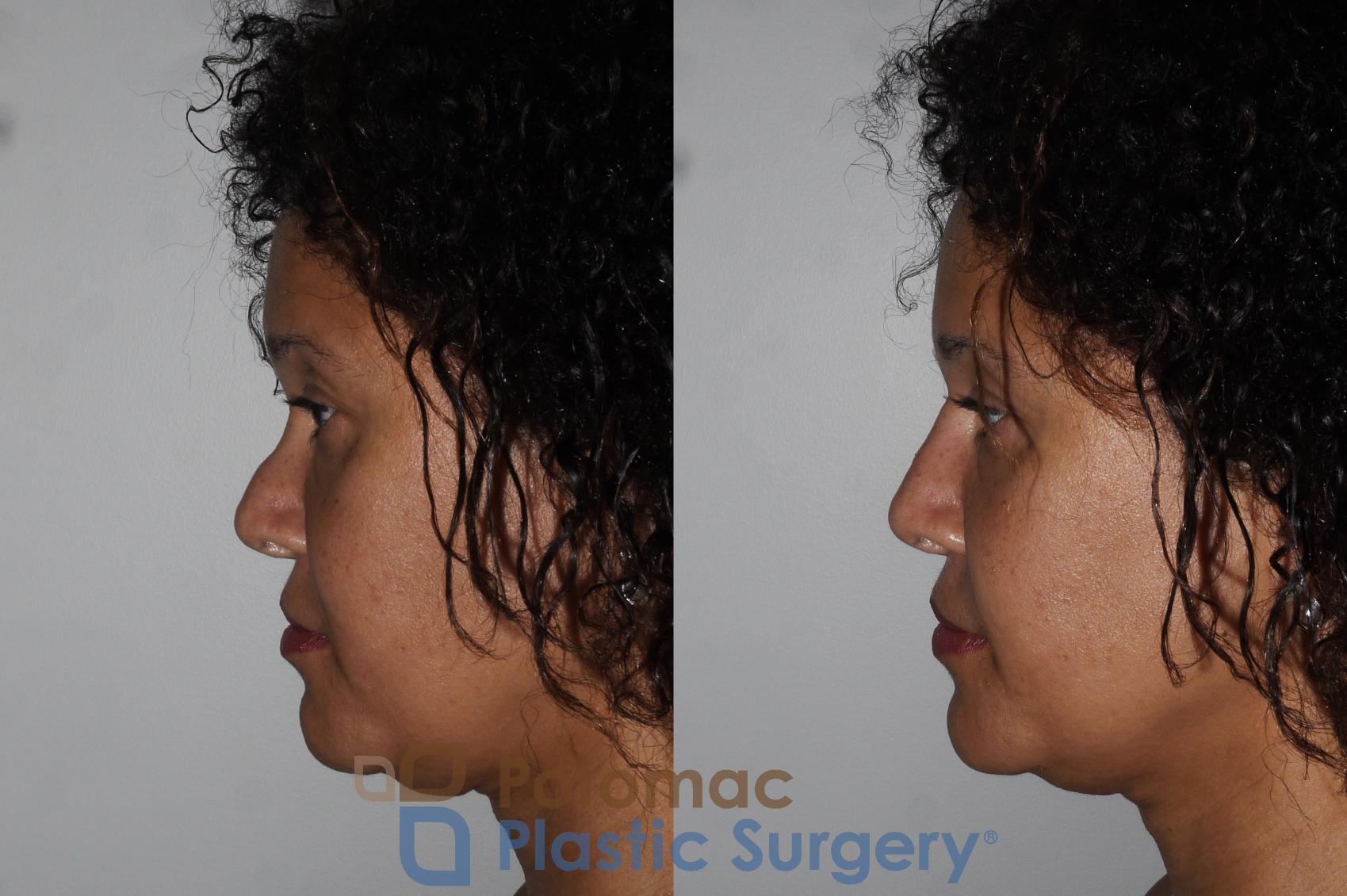 Before & After Dermal Fillers Case 209 Left Side View in Washington DC & Arlington , DC
