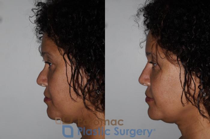 Before & After Rhinoplasty - Cosmetic Case 209 Left Side View in Washington DC & Arlington , DC