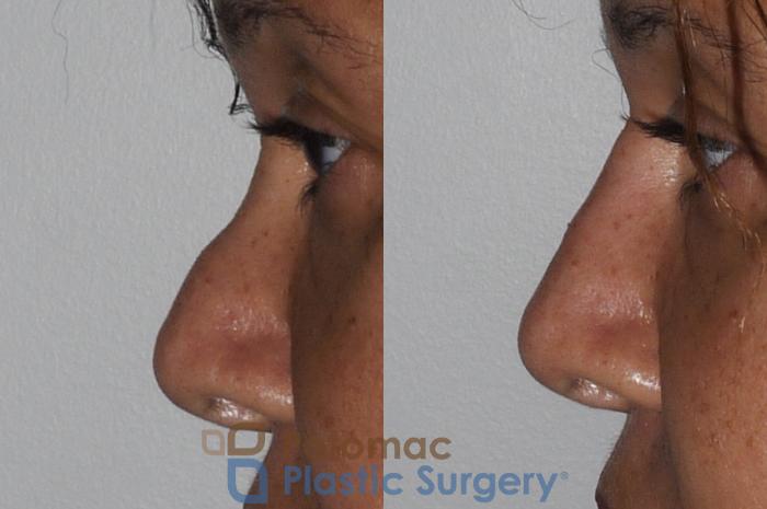 Before & After Rhinoplasty - Cosmetic Case 209 Left Side View Close-Up View in Washington DC & Arlington , DC