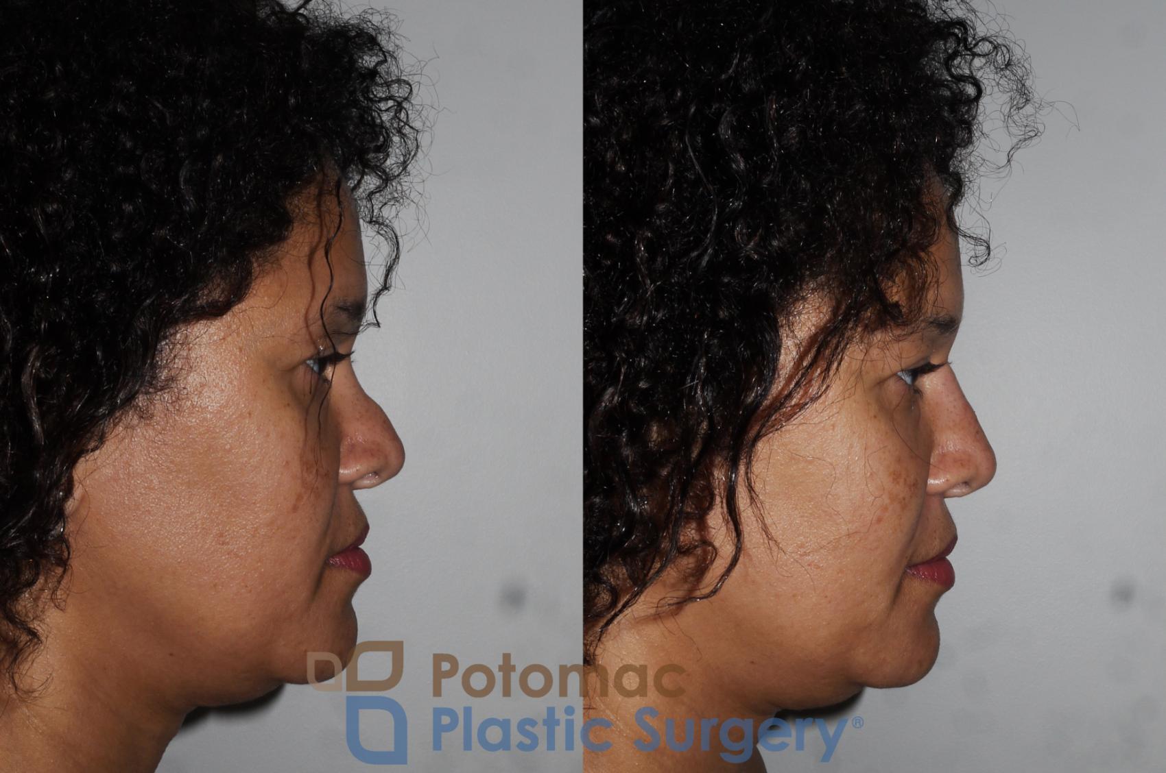 Before & After Dermal Fillers Case 209 Right Side View in Washington DC & Arlington , DC