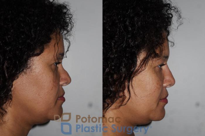 Before & After Rhinoplasty - Cosmetic Case 209 Right Side View in Washington DC & Arlington , DC