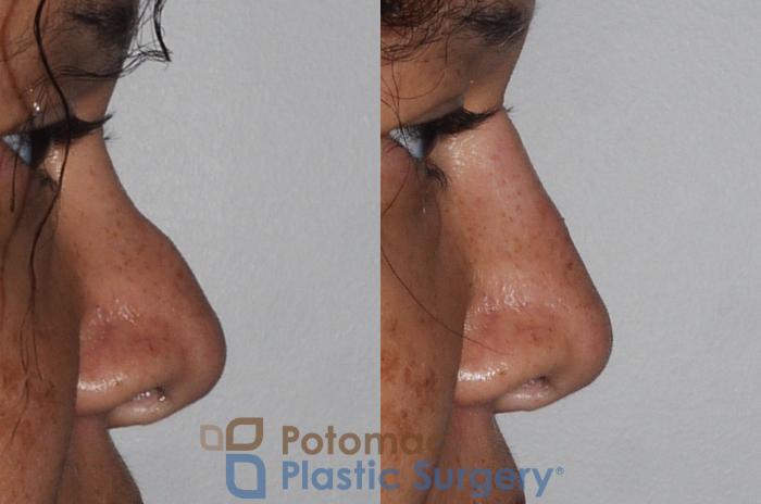 Before & After Rhinoplasty - Cosmetic Case 209 Right Side View Close-Up View in Washington DC & Arlington , DC
